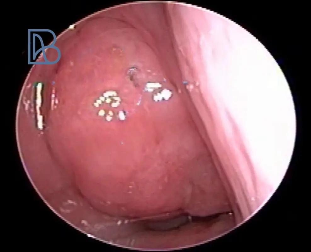 Vue endoscopique des végétations adénoïdes hypertrophiées avec des taches blanches, examinée par le Dr Benlyazid à Casablanca.
