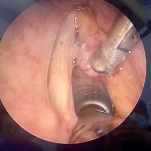 Exérèse chirurgicale d'un polype sur la corde vocale visible en endoscopie, utilisant des instruments spécialisés.
