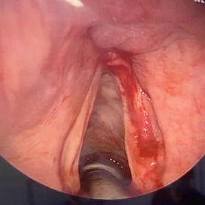 Vue endoscopique de la corde vocale droite après exérèse du polype, mettant en évidence l'intégrité du ligament vocal.