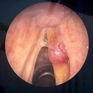 Endoscopie ORL montrant un polype angiomateux sur la corde vocale droite, caractérisé par une masse vasculairisée visible.