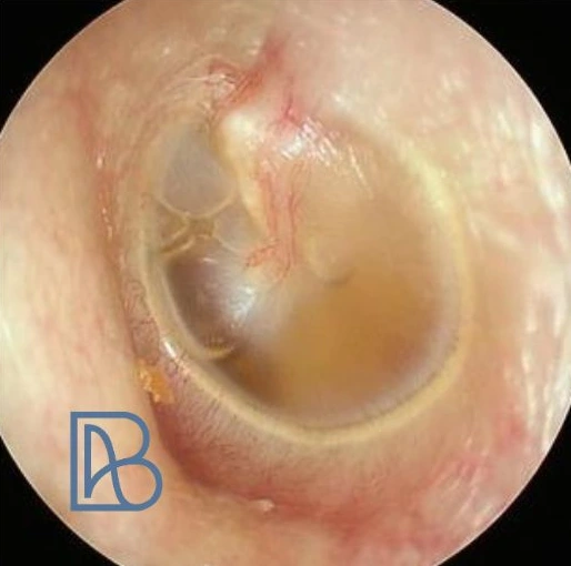 Tympan montrant une otite séromuqueuse avec un niveau liquide et des bulles dans l'oreille moyenne