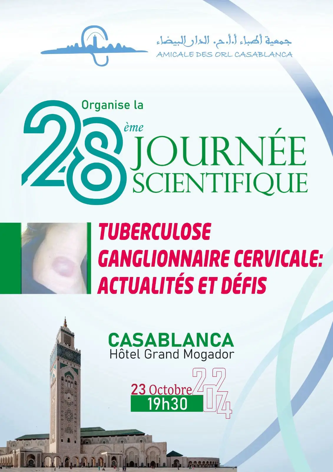 Focus sur la Tuberculose Ganglionnaire Cervicale
