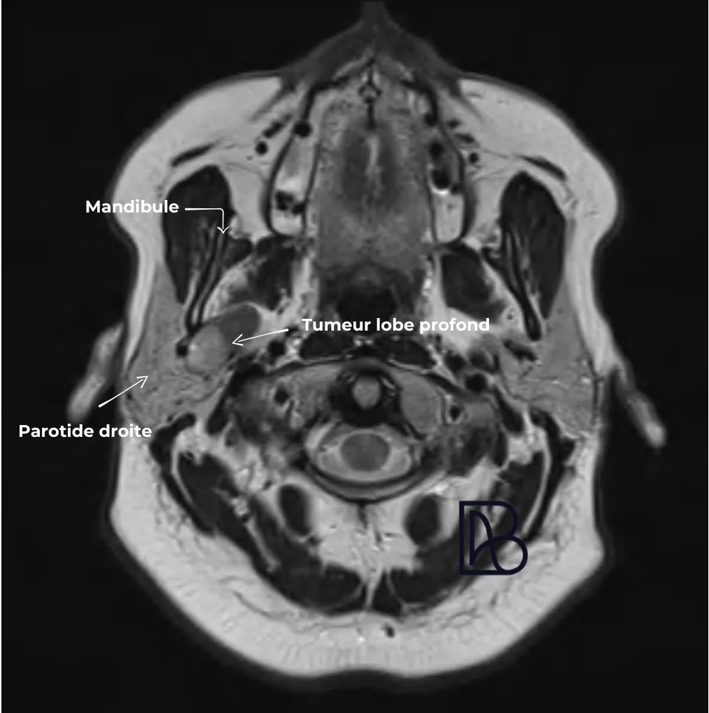 IRM T2 axial montrant une tumeur du lobe profond de la parotide droite, située en dedans de la mandibule avec un double contingent tumoral.