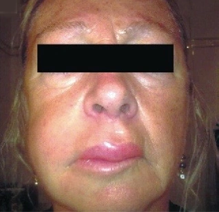 Photo d’un visage montrant un œdème de la joue droite dans le cadre d’un angio-œdème facial, une manifestation clinique liée à des réactions allergiques ou inflammatoires.