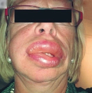 Un visage présentant un œdème marqué de la joue gauche et de la lèvre supérieure, indicatif d’un angio-œdème facial souvent lié à des réactions allergiques.