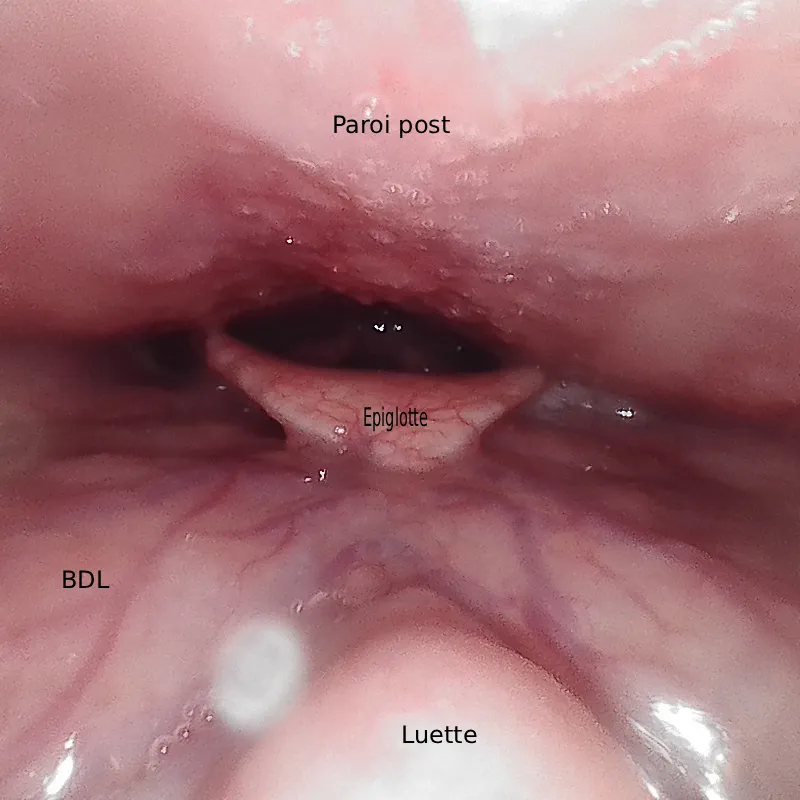 Image endoscopique de l’oropharynx chez un patient ronfleur, montrant une base de langue volumineuse rétrécissant l’espace rétro-basi-lingual et l’orifice respiratoire.