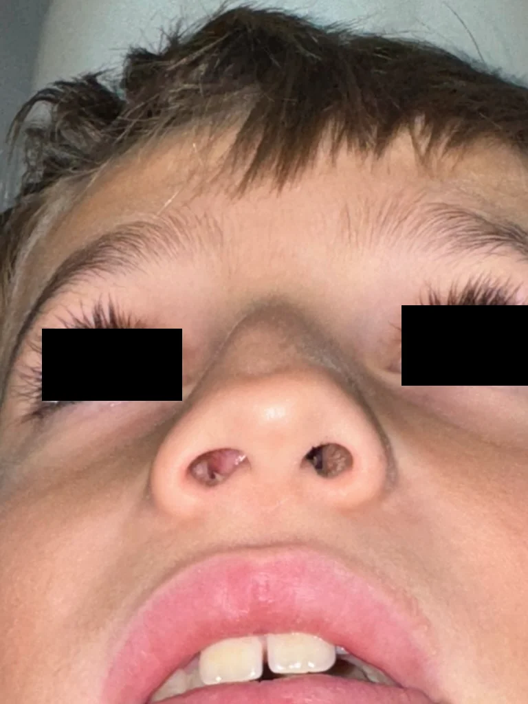 Déviation de la cloison nasale chez un enfant, montrant une asymétrie visible des narines due à une déformation du septum nasal.