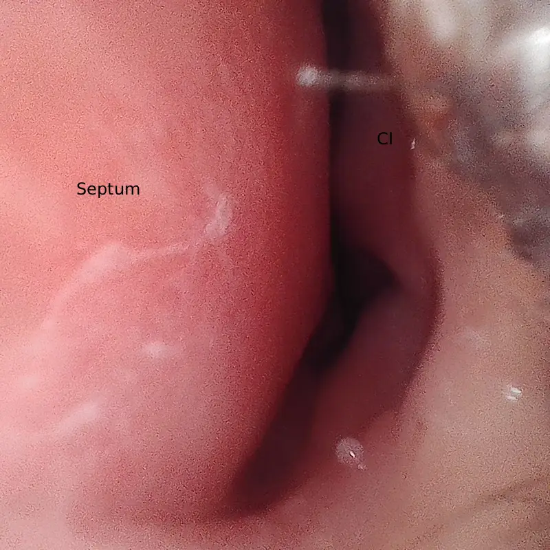 Image endoscopique de la fosse nasale gauche montrant une forte déviation de la cloison nasale obstruant la lumière nasale et réduisant le passage de l’air.
