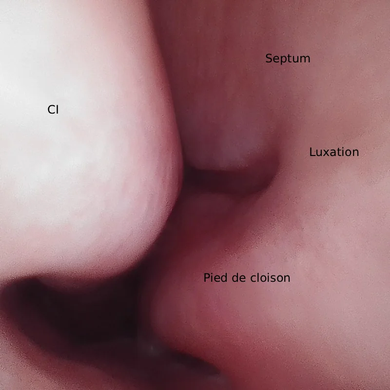 Image endoscopique de la fosse nasale droite montrant une luxation du septum nasal au niveau du pied de cloison, avec visualisation du cornet inférieur (CI).