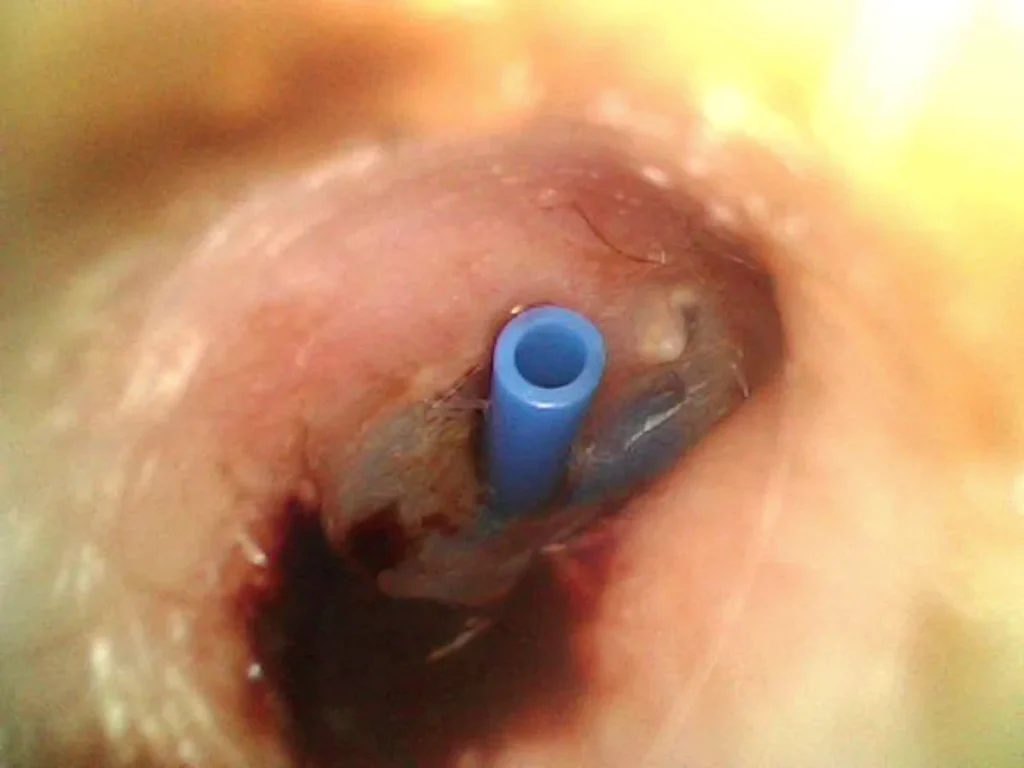 Image otoscopique montrant un T-tube de tympanostomie bleu (un des nombreux types d'aérateurs transtympaniques) en place à travers le tympan, utilisé pour aérer l’oreille moyenne et prévenir les otites séreuses chroniques.