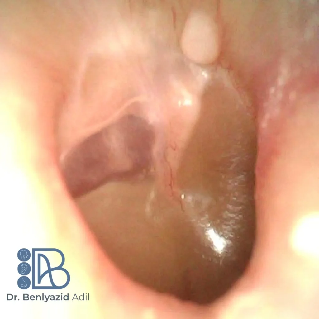 Image endoscopique du tympan droit montrant un épanchement muqueux dans l’oreille moyenne, signe typique d’otite séro-muqueuse. Traitement ORL par aérateurs transtympaniques réalisé par le Dr Benlyazid à Casablanca.