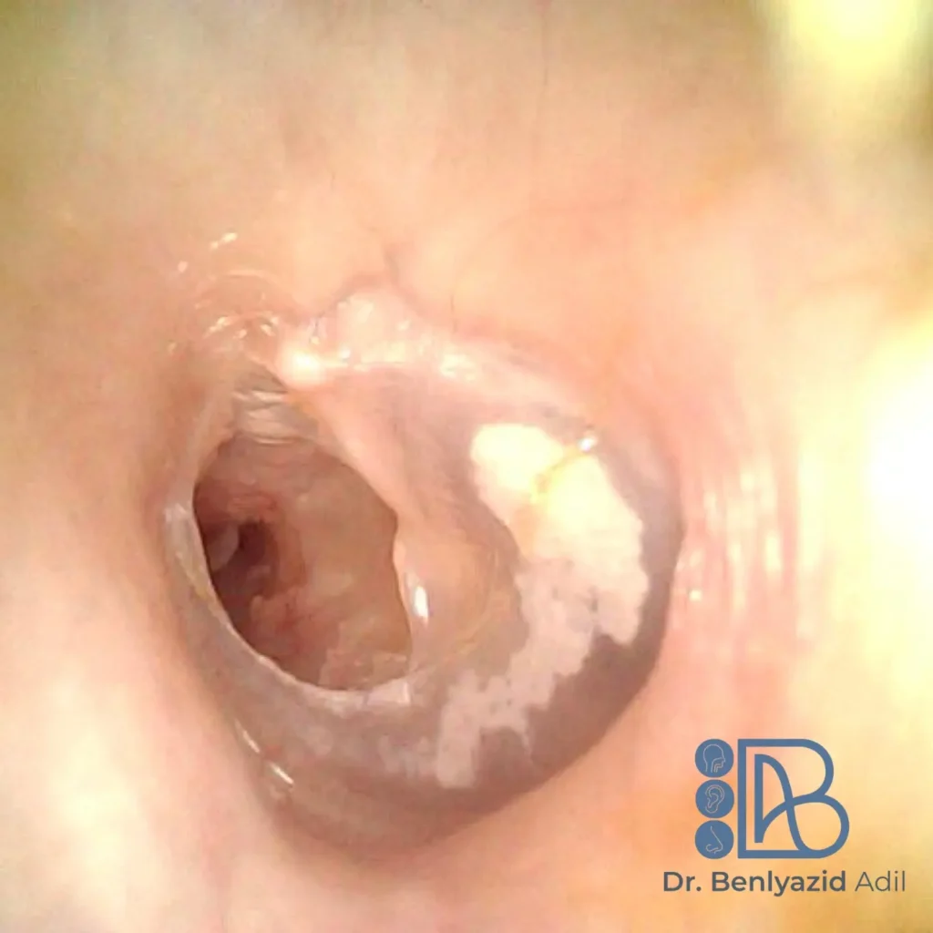 Image endoscopique du tympan gauche montrant une perforation antéro-supérieure consécutive à la pose d’un aérateur transtympanique de type T tube. Indication de myringoplastie. Suivi post-opératoire ORL par le Dr Benlyazid à Casablanca.