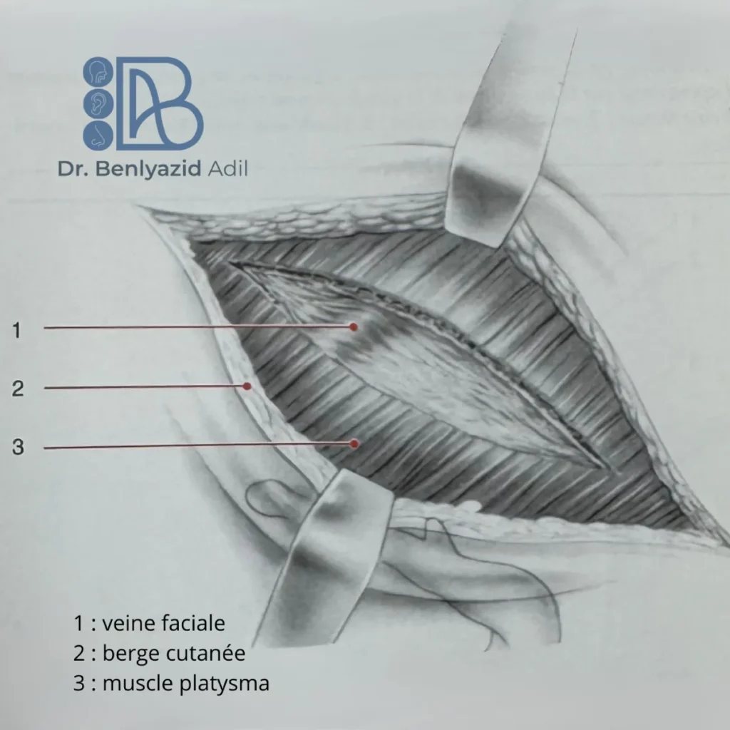 Dessin médical montrant l’incision du muscle platysma, l’exposition des berges cutanées et la dissection de la veine faciale.