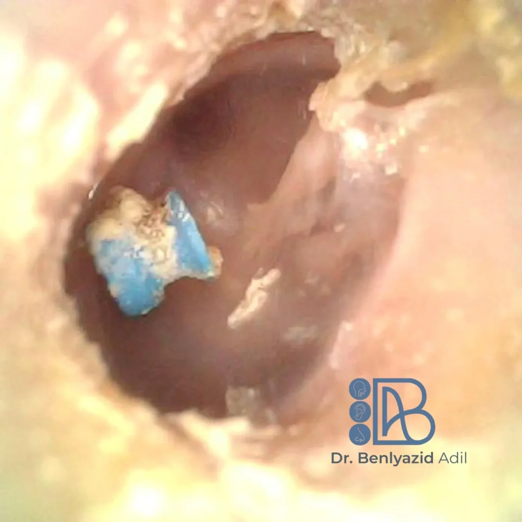 Image endoscopique montrant un aérateur transtympanique de type Shepard (yo-yo) expulsé du tympan gauche, avec cicatrisation naturelle. Suivi post-aérateur par le Dr Benlyazid ORL à Casablanca.