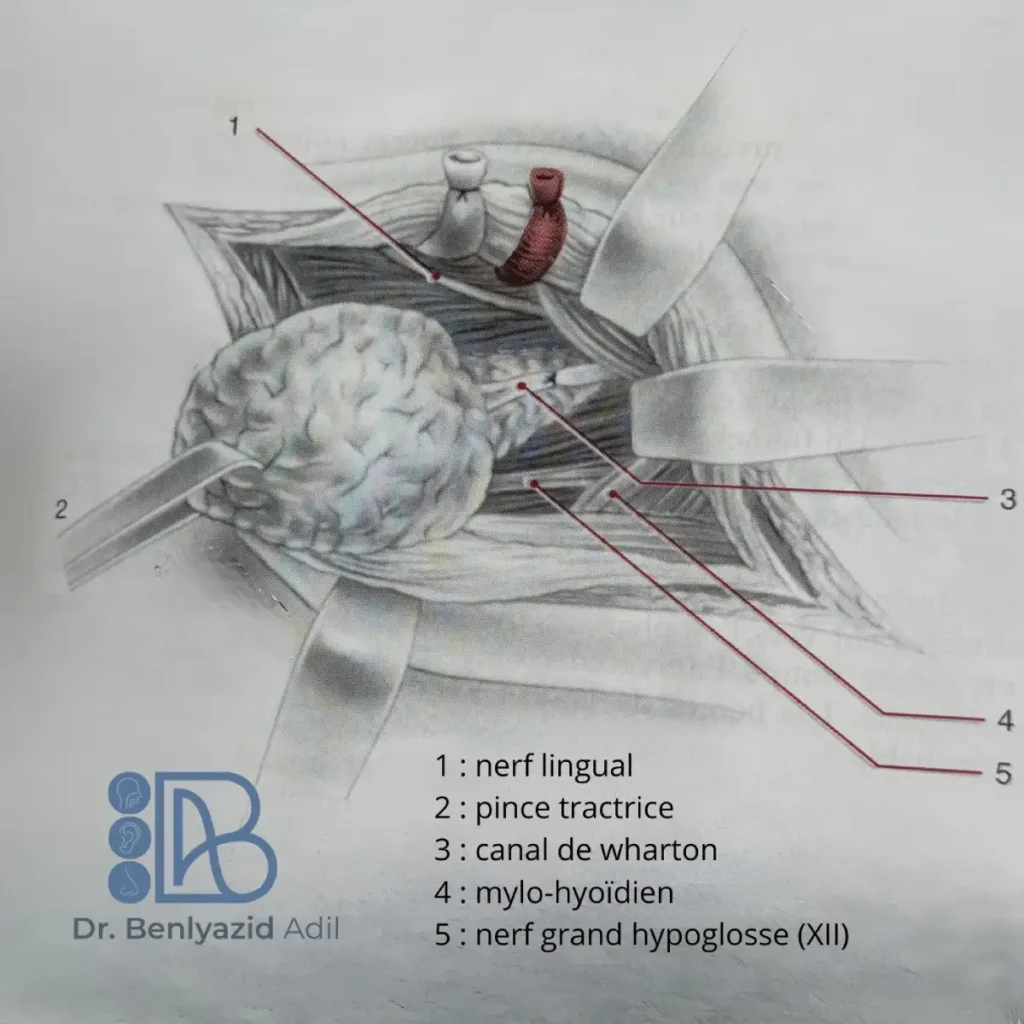 Dessin chirurgical montrant le nerf lingual, le canal de Wharton et le nerf hypoglosse lors d’une dissection de la glande sous-mandibulaire.