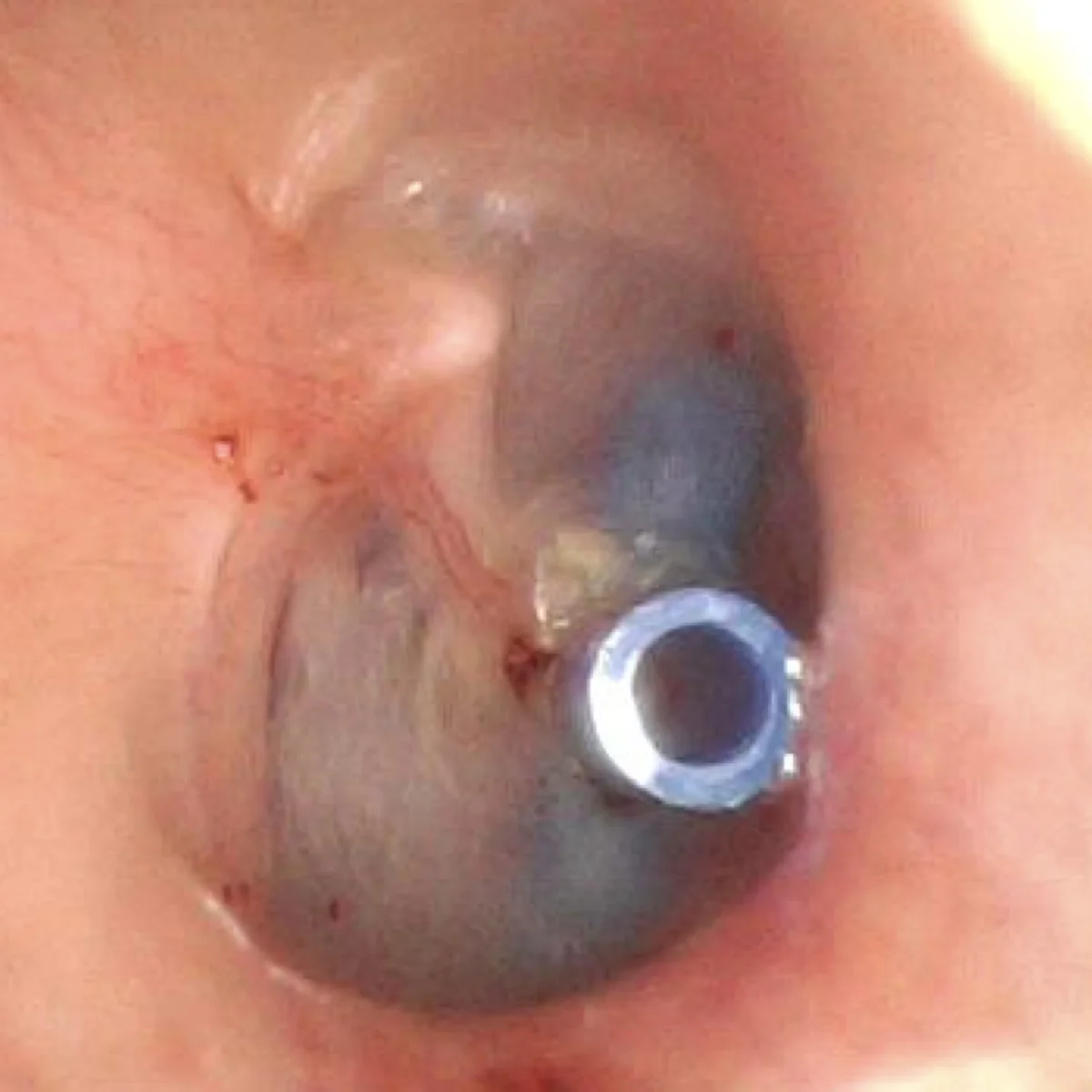 Vue endoscopique d’un aérateur transtympanique en place dans le tympan droit d’un patient.