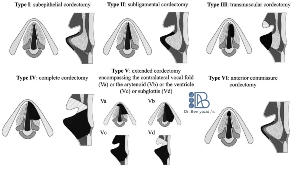 Schéma comparatif des différents types de cordectomie au laser selon la classification européenne, utilisé par le Dr Benlyazid ORL à Casablanca