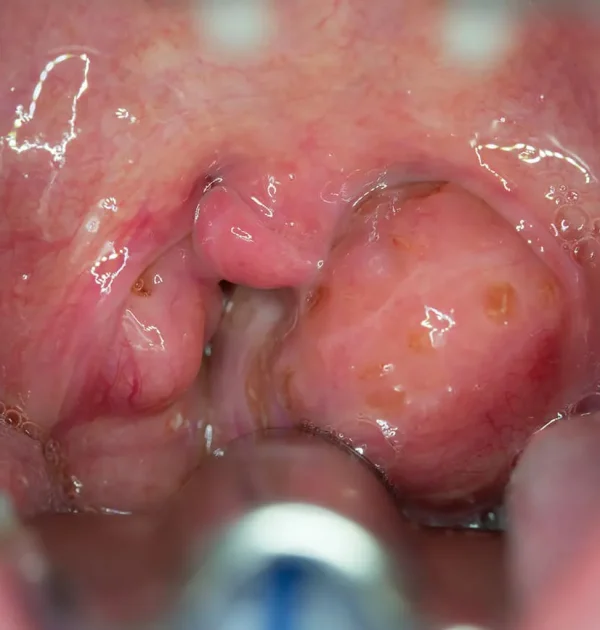 indication d'amygdalectomie Casablanca par le Dr Adil BENLYAZID (hypertrophie majeure des amygdales)